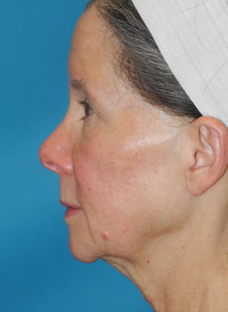 Facelift case #5457