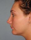 Rhinoplasty case #3694