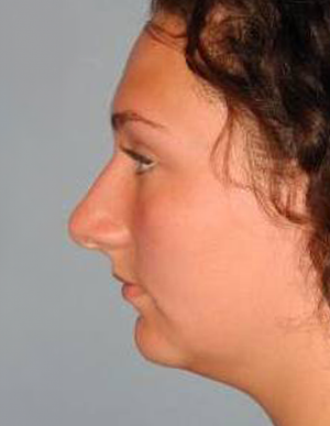 Rhinoplasty case #3694