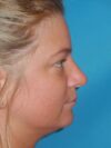 Rhinoplasty case #3806