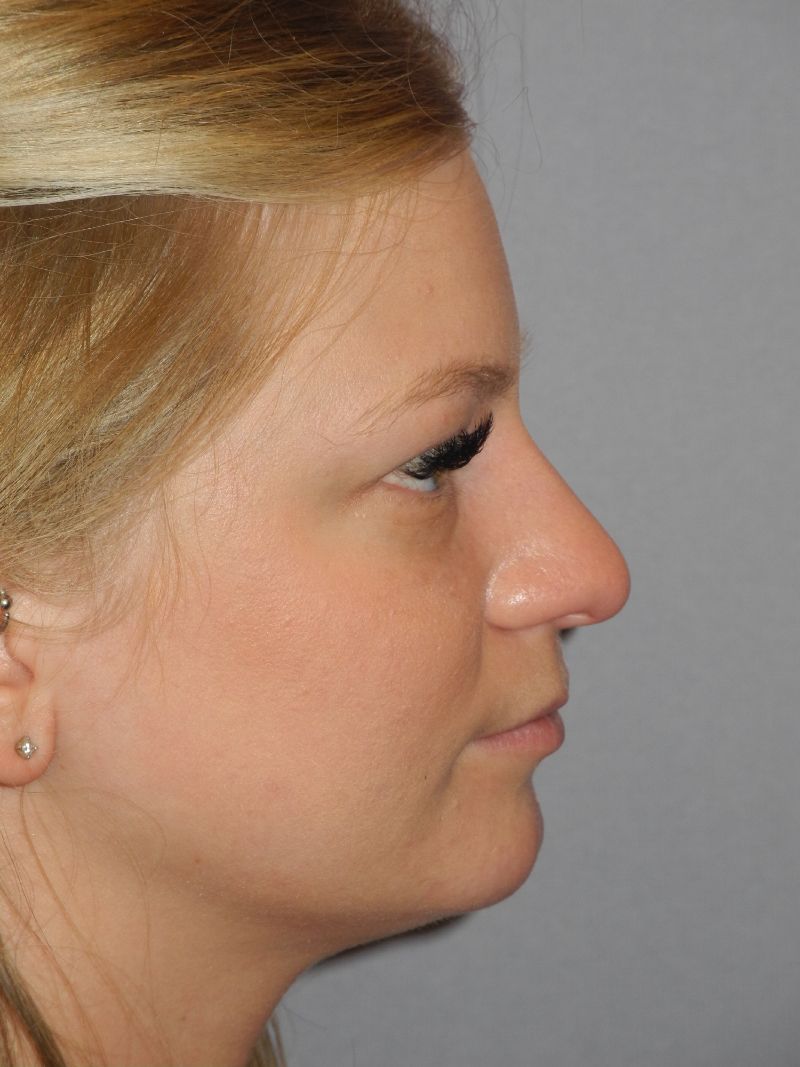 Rhinoplasty case #3806