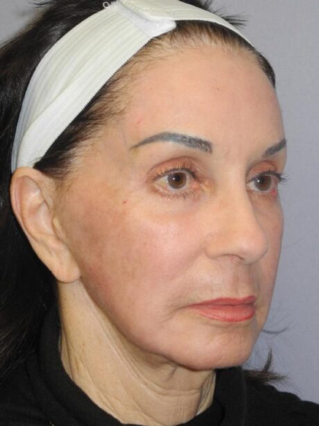 CO2 Laser Resurfacing case #5425