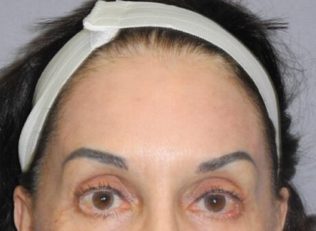 CO2 Laser Resurfacing case #5425