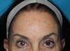 CO2 Laser Resurfacing case #5425