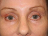 Blepharoplasty case #5472