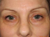 Blepharoplasty case #5472