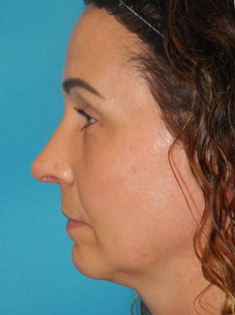 Rhinoplasty case #4169