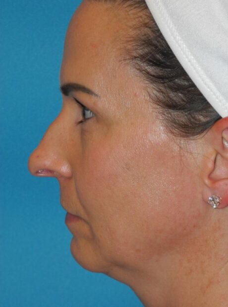 Rhinoplasty case #4169