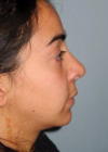 Rhinoplasty case #3906