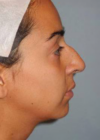 Rhinoplasty case #3906