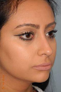 Rhinoplasty case #3905