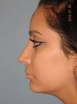 Rhinoplasty case #3905