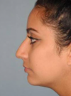 Rhinoplasty case #3905