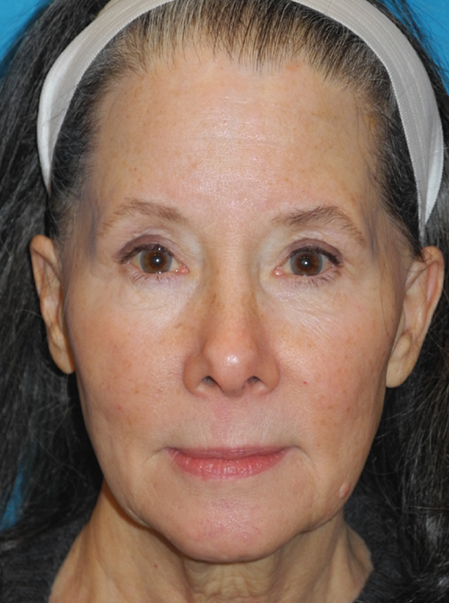 Facelift case #5457