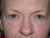 Blepharoplasty case #6468