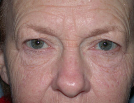 Blepharoplasty case #4948