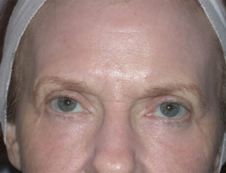 Blepharoplasty case #4948