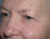 Blepharoplasty case #6468