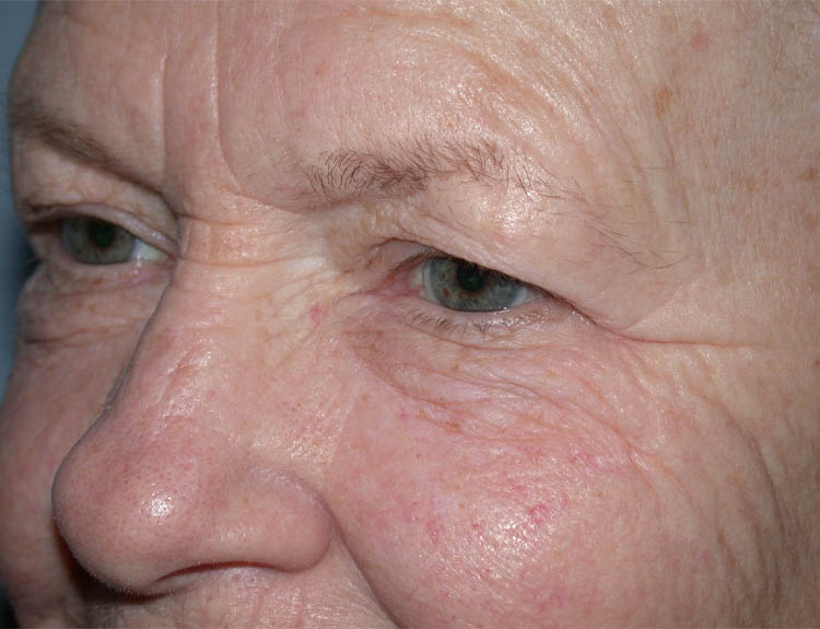 Blepharoplasty case #4948