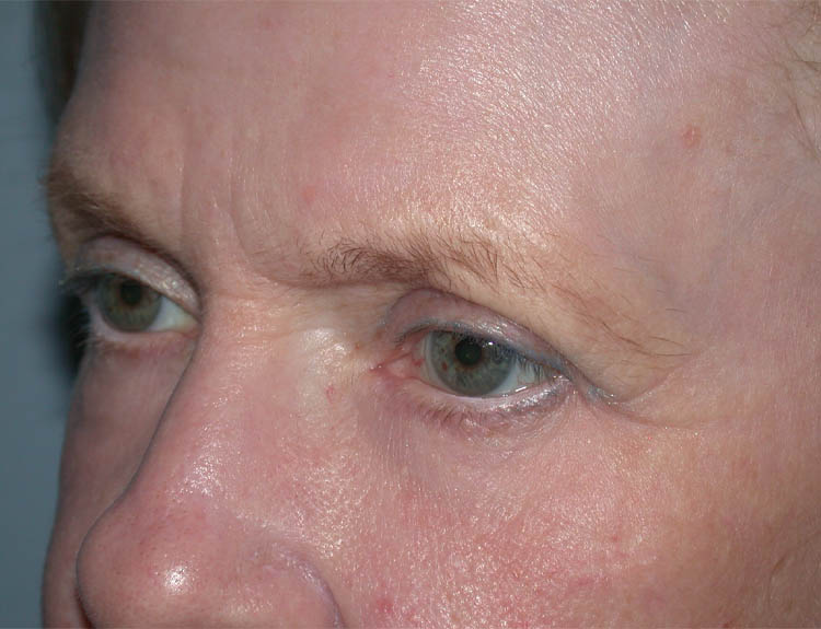 Blepharoplasty case #4948