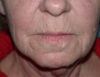 Blepharoplasty case #6468