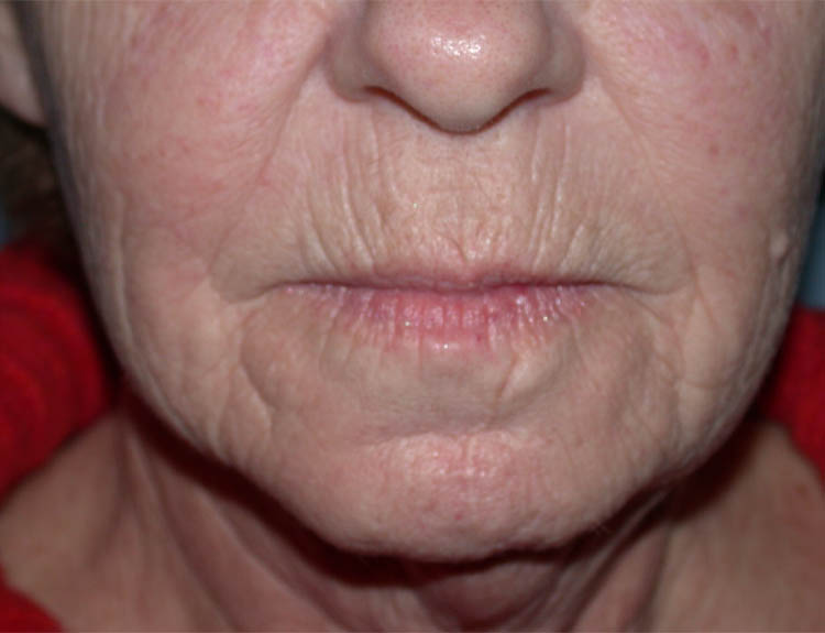 CO2 Laser Resurfacing case #4948