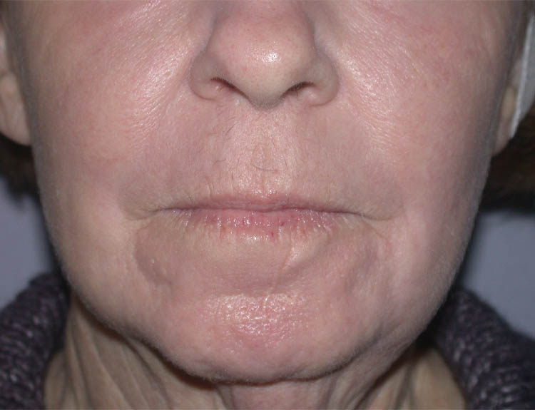 CO2 Laser Resurfacing case #4948