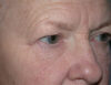 Blepharoplasty case #6468