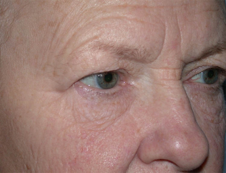 Blepharoplasty case #4948