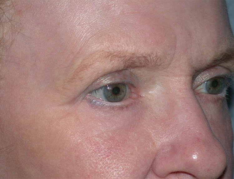 Blepharoplasty case #4948