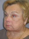 Blepharoplasty case #4470