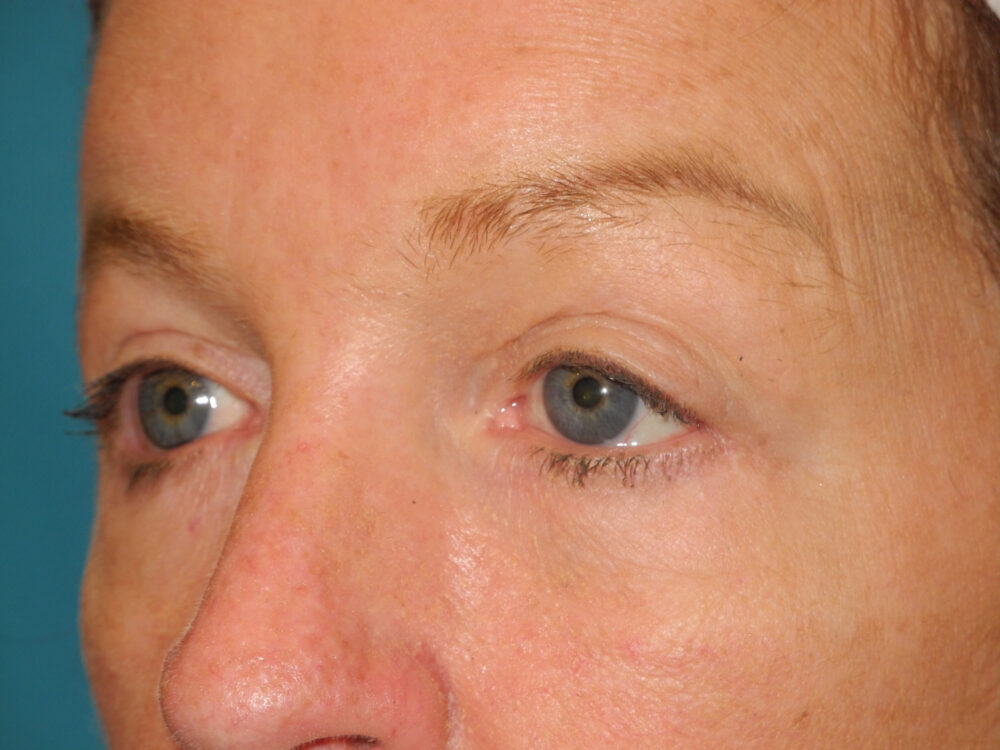 Blepharoplasty case #4024