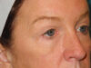 Blepharoplasty case #6473