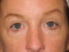 Blepharoplasty case #6473