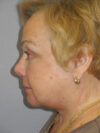 Blepharoplasty case #4470