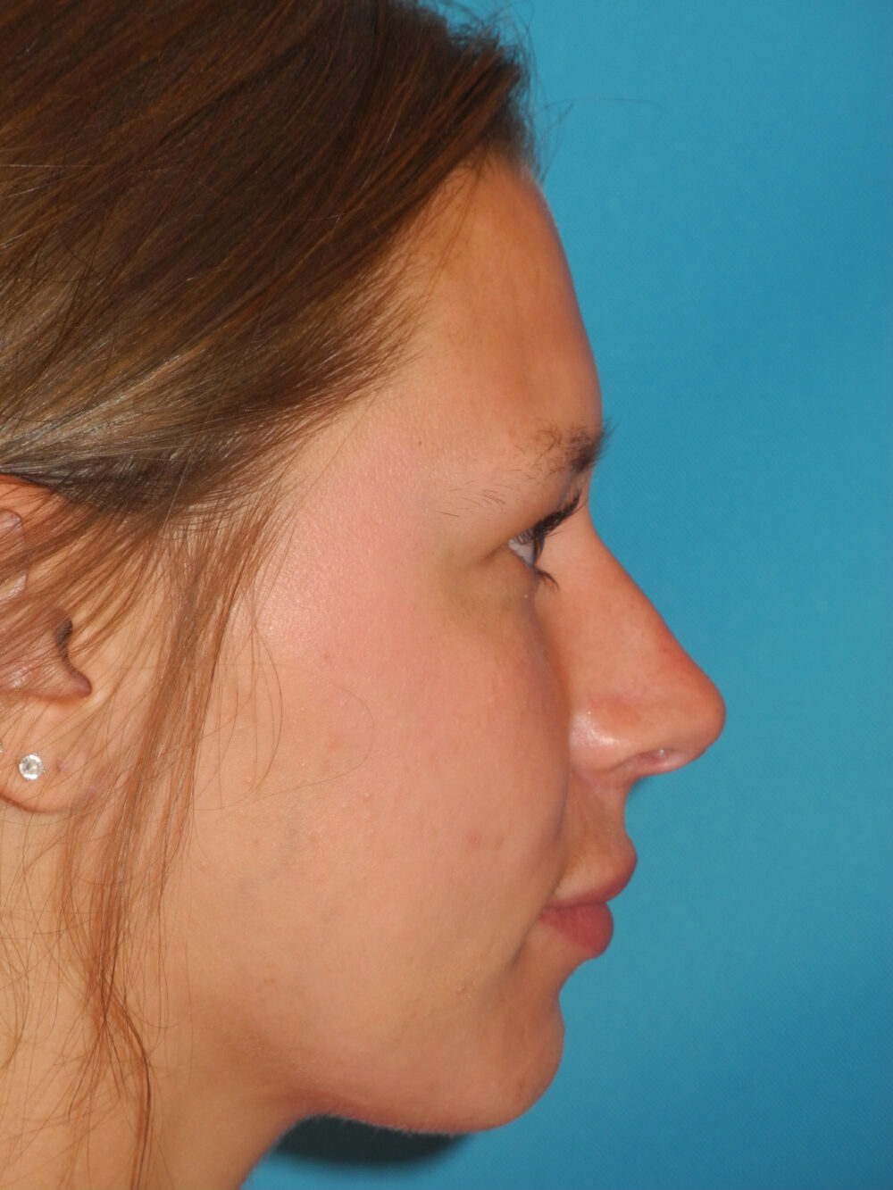 Liquid Rhinoplasty case #4428