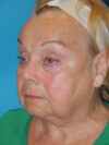 Blepharoplasty case #4470