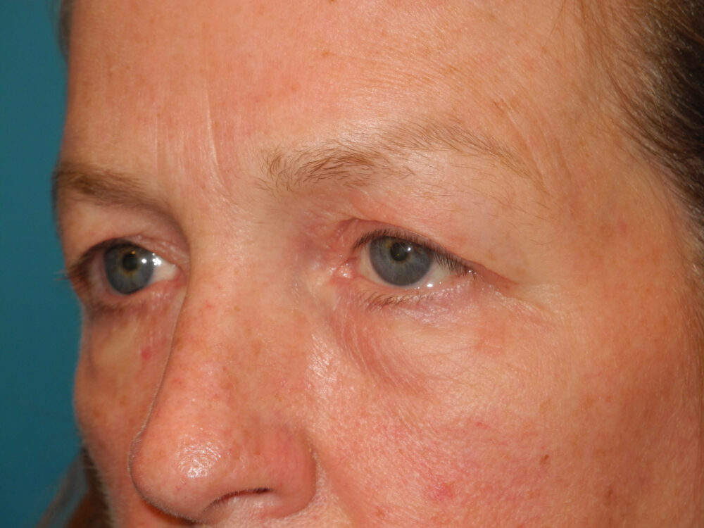 Blepharoplasty case #6473