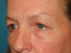 Blepharoplasty case #4024