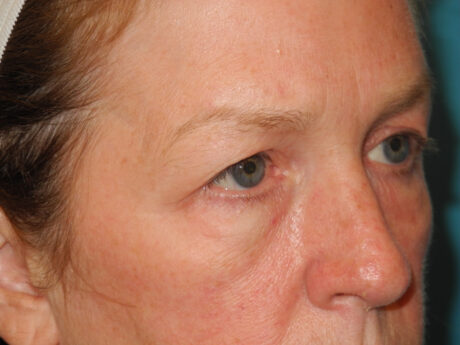 Blepharoplasty case #6473