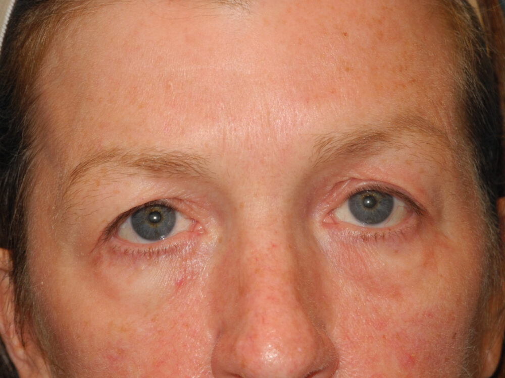 Blepharoplasty case #4024