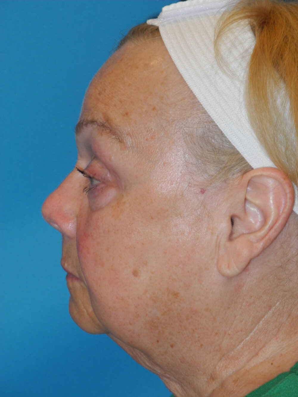 Blepharoplasty case #4470