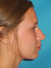 Liquid Rhinoplasty case #4428