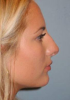 Rhinoplasty case #3691