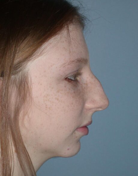 Rhinoplasty case #3510