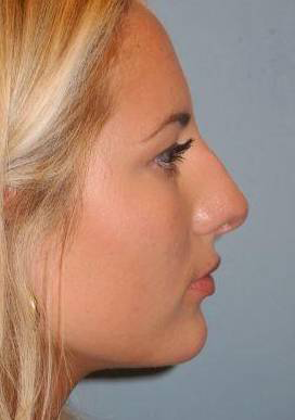 Rhinoplasty case #3691