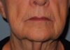 CO2 Laser Resurfacing case #4539