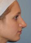 Rhinoplasty case #3692