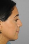 Rhinoplasty case #3518