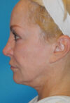 CO2 Laser Resurfacing case #4635